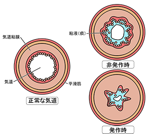 気管支のリモデリングって何